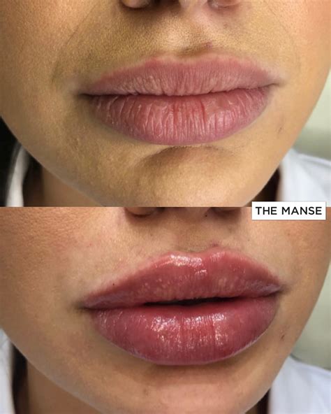 Lip Fillers Best Clinic Sydney For Dermal Fillers