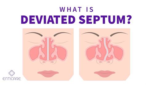 What Is Deviated Septum Enticare Ear Nose And Throat Doctors