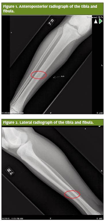 Dull Ache In Shin Bone