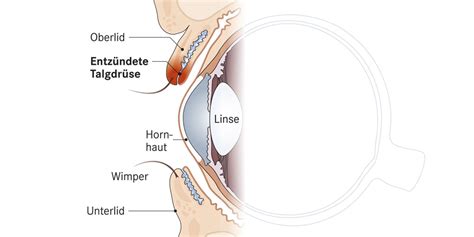 Das hagelkorn, medizinisch auch chalazion genannt, beginnt langsam und schleichend. Was ist ein Hagelkorn? Wie behandelt man es? | Apotheken ...