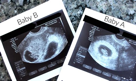Week Ultrasound Pictures Twins