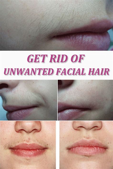 Get Rid Of Unwanted Facial Hair Everything In One Place