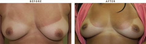 Inverted Nipple Before And After Pictures Dr Turowski Plastic Surgery Chicago