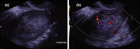 Detecting Endometrial Cancer Jones 2021 The Obstetrician