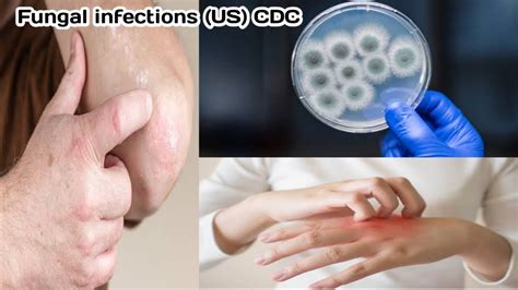 Fungal Infections Spreading In Us At Alarming Rate Says Centers For