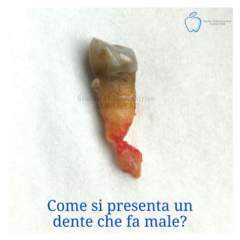 Come Si Presenta Un Dente Che Fa Male Così Studio Odontoiatrico