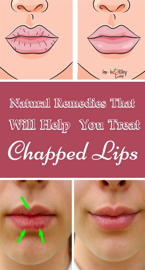 Natural Remedies That Will Help You Treat Chapped Lips Chapped Lips