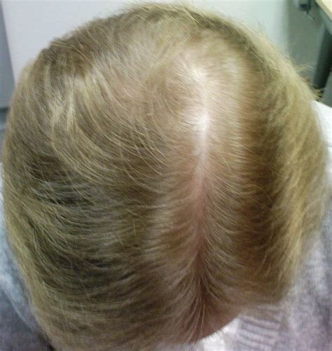 The Hair Loss Centre Female Hair LossBEFORE