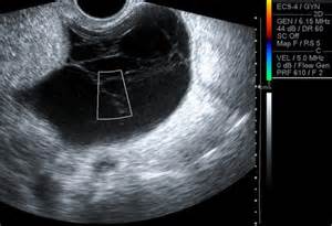 Transvaginal Ultrasound Multilocular Cystic Left Adnexal Lesion