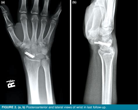 Figure From Treatment Of Acute Perilunate Dislocation Or Fracture Dislocation Using Dorsal