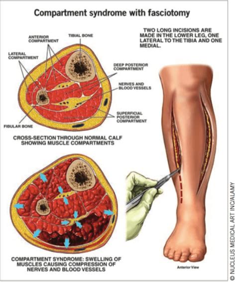 Is Delta Pressure Accurate For Compartment Syndrome County Em