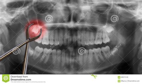 Orthodontic Tool Show Wisdom Tooth Stock Photo Image Of Bite