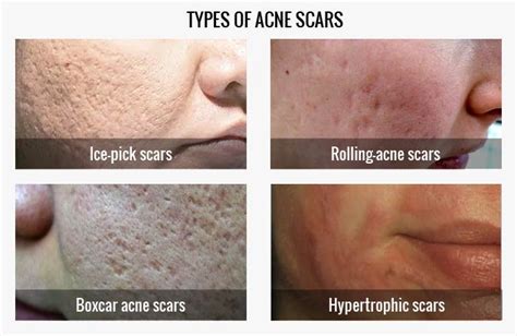 Types Of Acne Scars