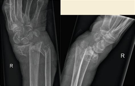 Extra Articular Distal Radius Fractures With Metaphyseal Comminution