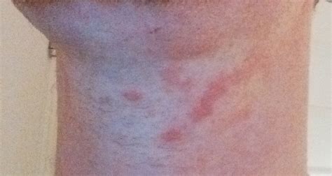 Started Getting Red Spots On My Neck What Skin Condition Is This