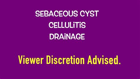Sebaceous Cyst Medically Drained On Black Person Cellulitis Youtube