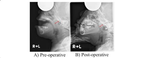 Pre And Postoperative Lateral View Radiographs Of The Nasopharynx A