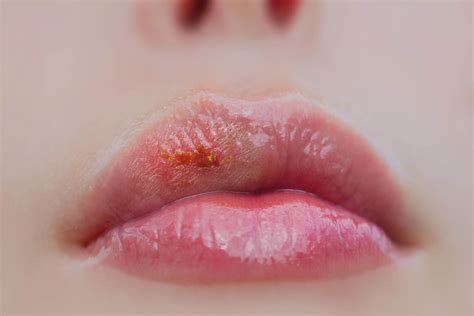 The Most Common Mouth Infections Part Cold Sore VitalEurope