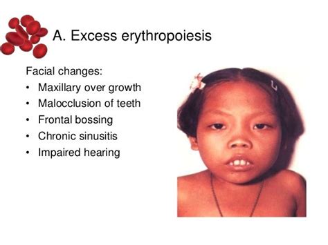 Thalassemia Face