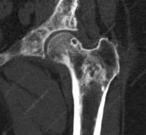 Hip Metastases Ct Scan Stock Image C0393268 Science Photo Library