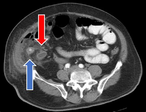 Cureus A Rare Complication Of Perforated Appendicitis A Case Of