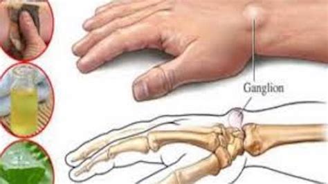4 Home Remedies For Ganglion Cysts Youtube