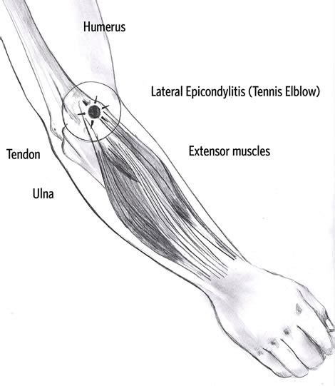 About Health Tennis Elbow