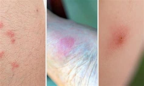 Bed Bugs Vs Hives How To Tell If Its Just A Bite Or An Allergic Reaction