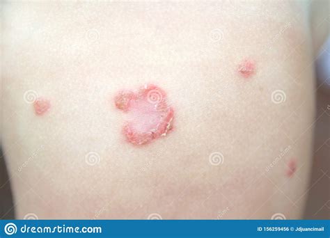 Contagious Bacterial Dermatologic Infection Impetigo On A Child Skin