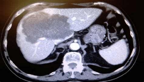 Huge Liver Metastasis In A 64 Year Old Patient With Colon Cancer First