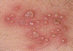Summary of test principle and clinical relevance. About Herpes Page 44