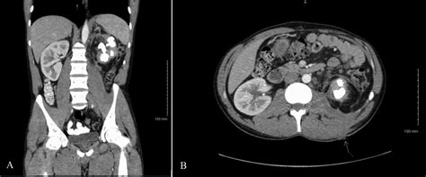 Contrast Enhanced Computed Tomography Images From Initial Presentation