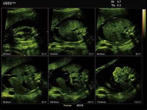 Ultrasound Images • Fetal Abdomen Ascites Msv Echogramm №629