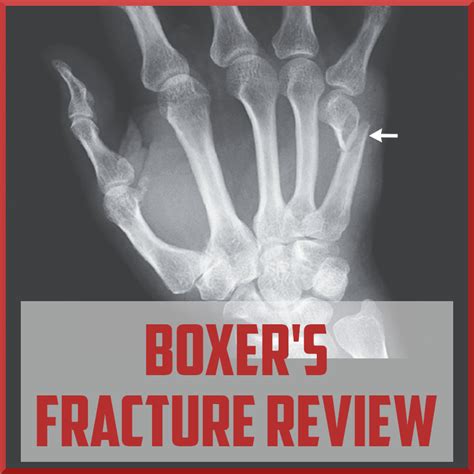 Review Of Boxers Fracture Sports Medicine Review