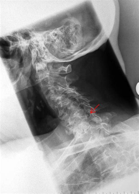 Oblique Cervical Spine Technique Wikiradiography