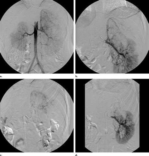 Embolization Of Giant Renal Angiomyolipomas Technique And Results