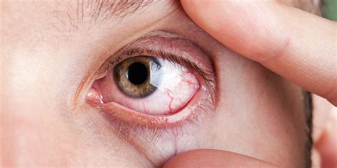 Dry Eye Syndrome Symptoms Brooks Eye Associates