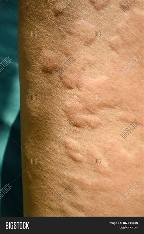 Photos Reaction To Use Skin Rash Urticaria Allergic S