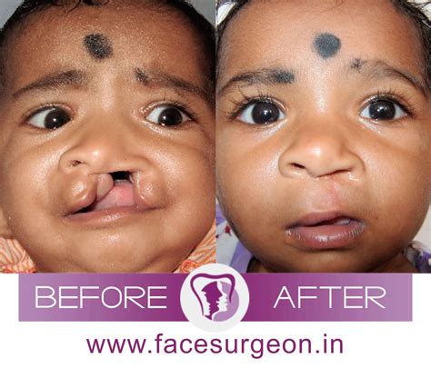 Cleft Palate Revision Surgery In India All That You Wanted To Know