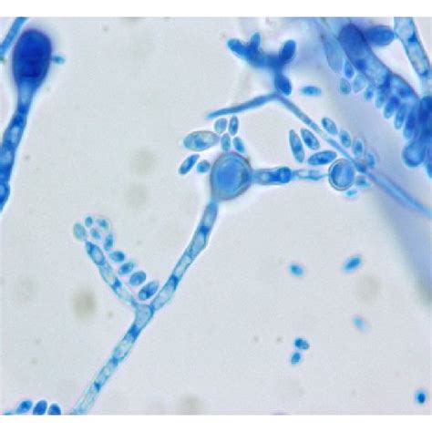 Gram Stain Of Blood Culture Showing Gram Negative Septated Hyphae And