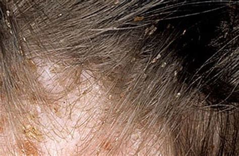 Awesome What Do Lice Eggs Look Like On Hair The Full Post From