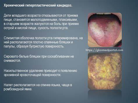 Диета кандидоз рта