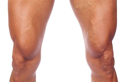 How Your Workout Can Lead To Varicose Veins San Diego