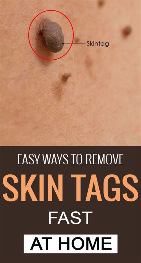 top 10 home remedies to remove skin tags naturally skin tag removal remove skin tags