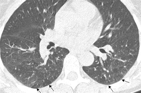 Differences In Regional Air Trapping In Current Smokers With Normal