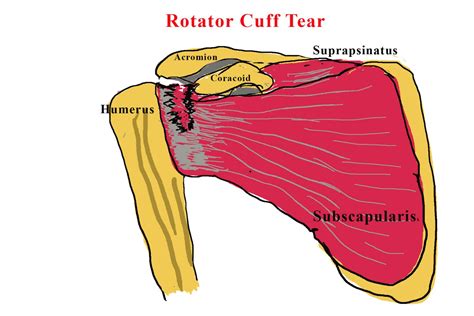 Rotator Cuff Tears Do Steroid Injections Work Gp Voice