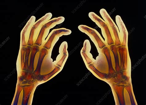 Coloured X Ray Of Healthy Human Hands Stock Image P1160415