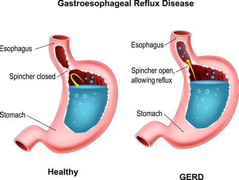 Gerd Or Acid Reflux Symptoms Diagnosis And Treatment Healthsoul