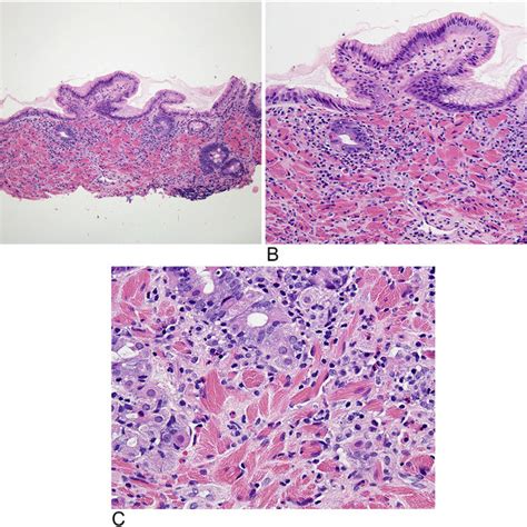 Hematoxylin And Eosin Stain Of Gastric Mucosal Biopsy A B Gastric