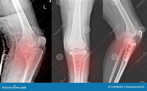 X Ray Knee Joint Fracture Proximal Tibia And Post Fix Fracture Proximal